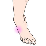 膝変形性関節症のo脚のメカニズム Bonesetter S Note