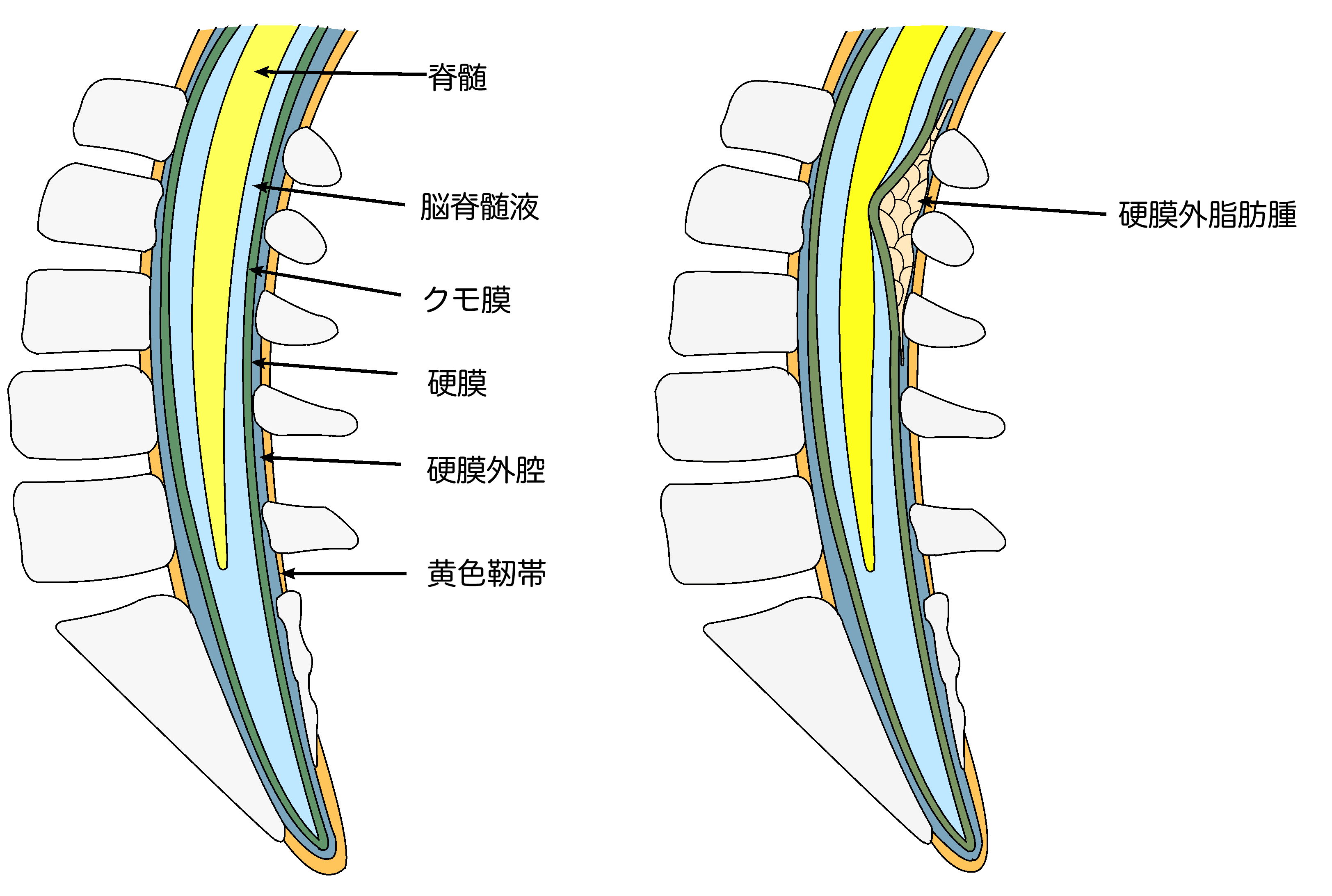 硬膜外関連の腰痛の症状