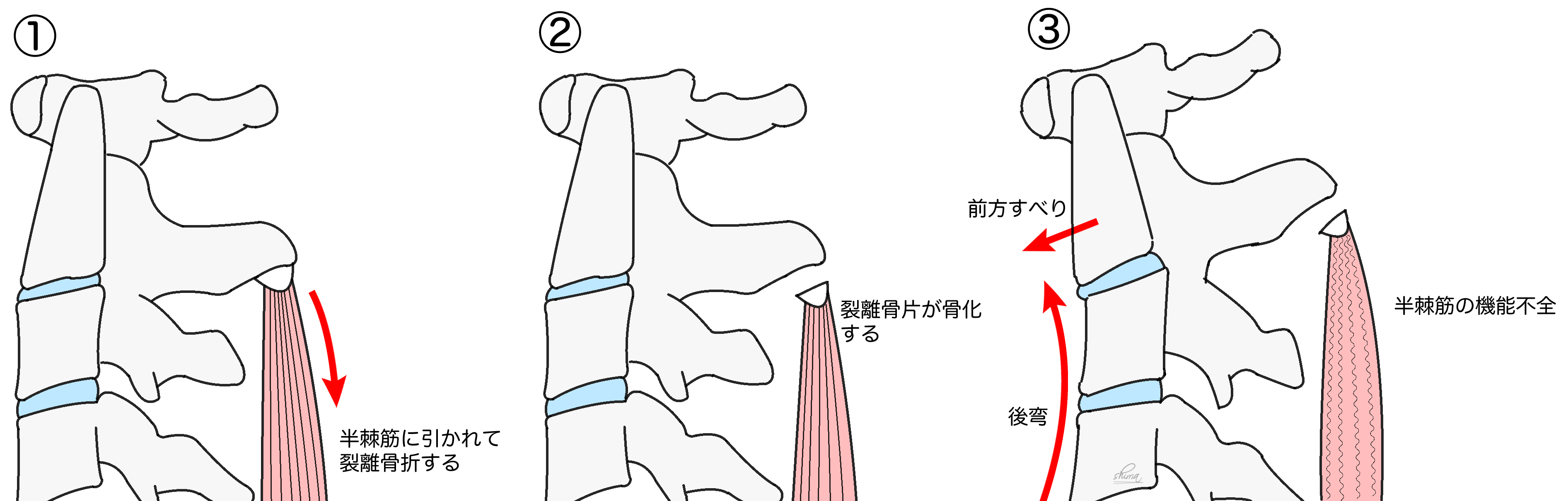 子供の軸椎棘突起の骨端裂離